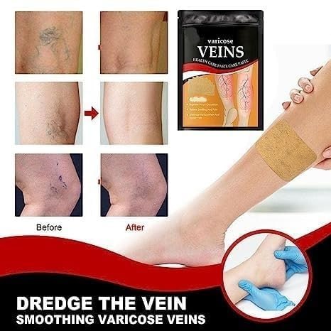 Varicose Veins Patches (BUY 1 GET 1 FREE)